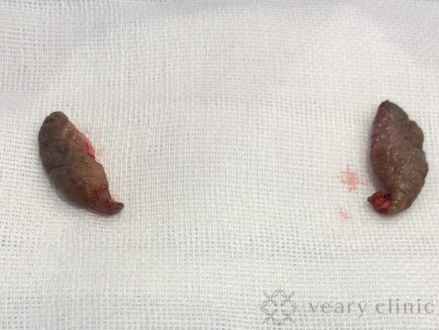 カットした小陰唇