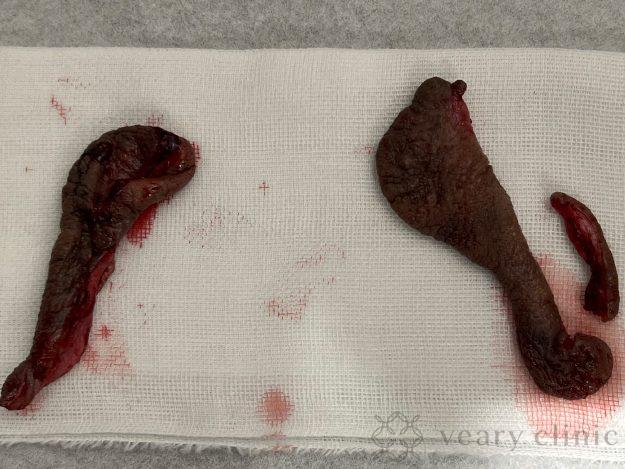 カットした小陰唇