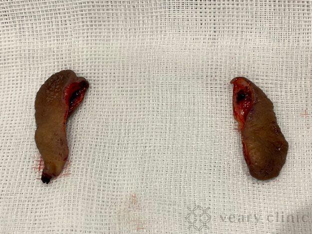 カットした小陰唇