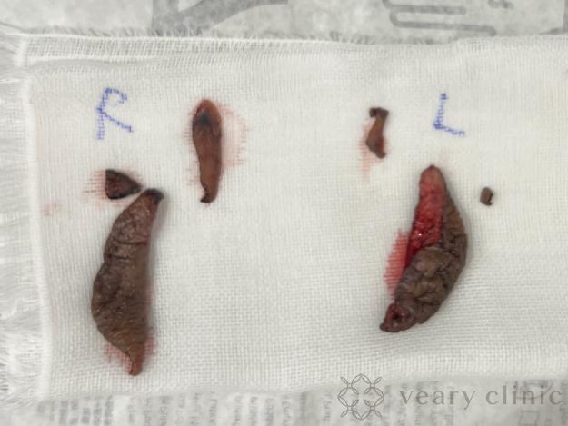 カットした小陰唇